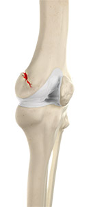 Knee Fracture