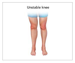 Knee Instability